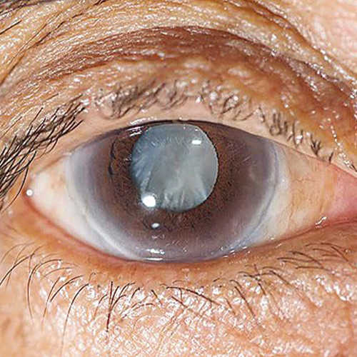 مشکلات بینایی در سالمندان - آب مروارید